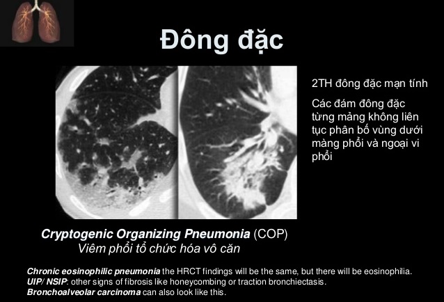 Phổi đông đặc - Hình ảnh minh họa